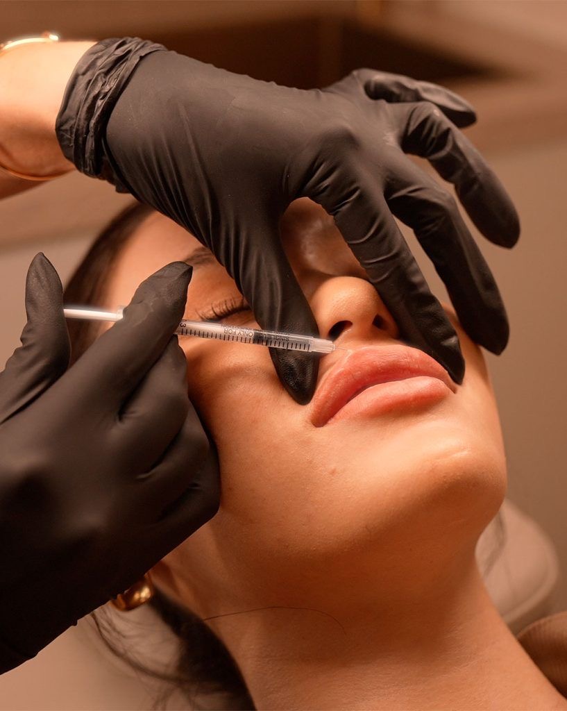 Preechimento Labial